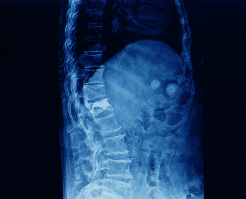 X-ray of spine in osteoporosis patient showing vertebral fracture