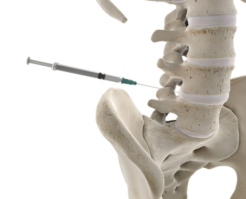 3D illustration of a lumbar spine injection