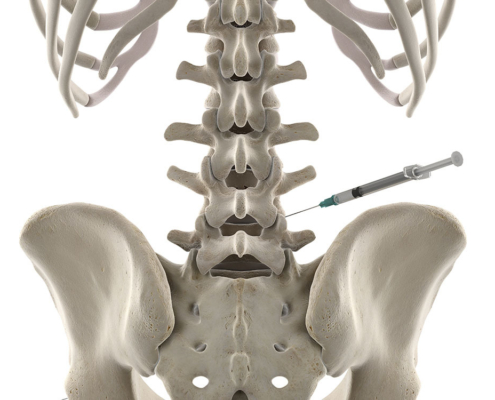 3D illustration of a lumbar spine injection