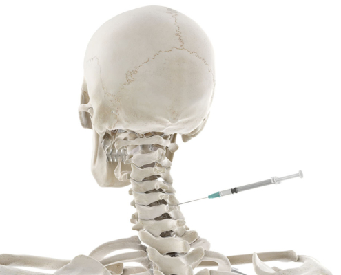 Back of skeleton with syringe going into neck spine area
